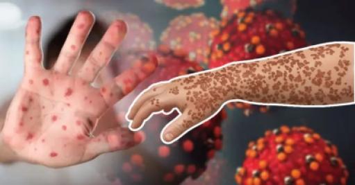 Rising Rate of Measles Infection and Child Mortality in Bangladesh